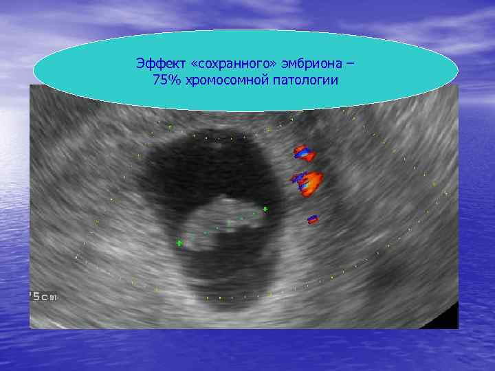 Эффект «сохранного» эмбриона – 75% хромосомной патологии 