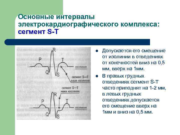 Дрейф изолинии на экг что это. Изолиния на ЭКГ. Интервалы и сегменты ЭКГ. Ст на изолинии ЭКГ. Элементы ЭКГ зубцы интервалы сегменты.