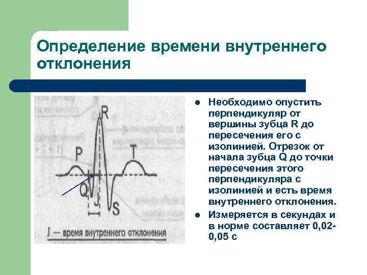 Дрейф изолинии на экг что это