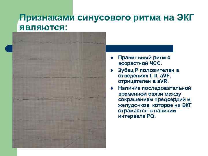 Признаками синусового ритма на ЭКГ являются: l l l Правильный ритм с возрастной ЧСС.