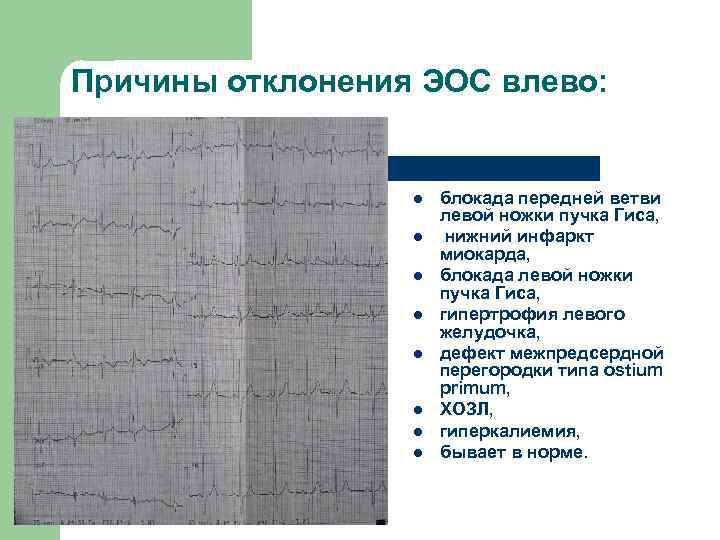 Эос экг что значит. Смещение оси влево на ЭКГ. Смещение электрической оси сердца влево на ЭКГ. ЭКГ гипертрофия левого желудочка ритм синусовый отклонение ЭОС влево. ЭКГ отклонение электрической оси влево что это.