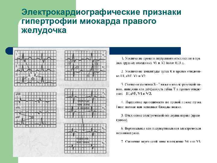 Электрокардиографические признаки гипертрофии миокарда правого желудочка 