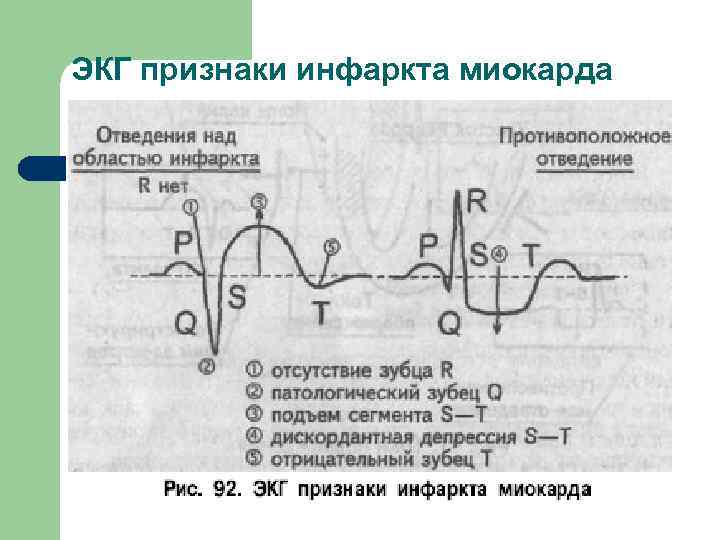 ЭКГ признаки инфаркта миокарда 