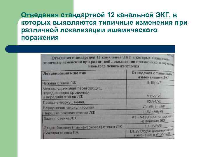 Отведения стандартной 12 канальной ЭКГ, в которых выявляются типичные изменения при различной локализации ишемического