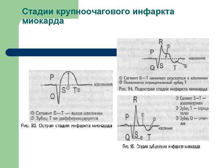 Стадии крупноочагового инфаркта миокарда 
