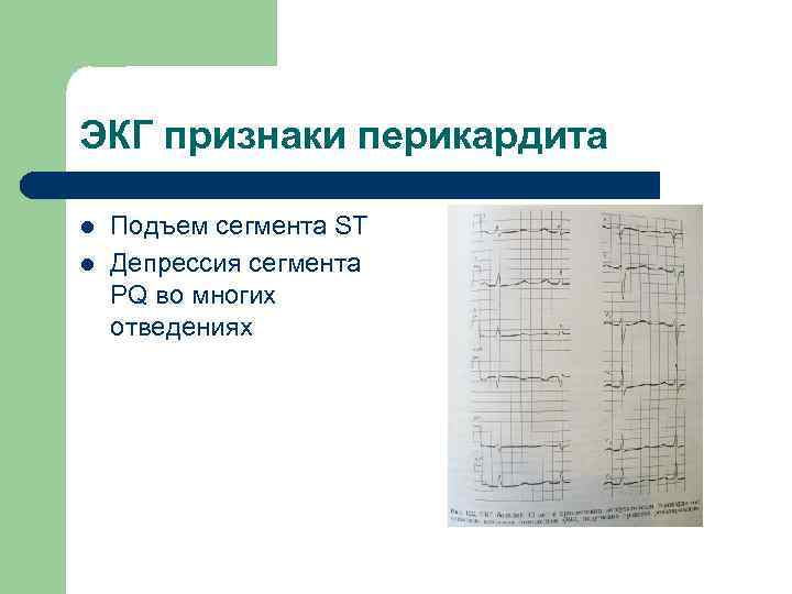 ЭКГ признаки перикардита l l Подъем сегмента ST Депрессия сегмента PQ во многих отведениях