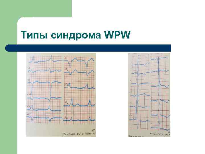 Типы синдрома WPW 