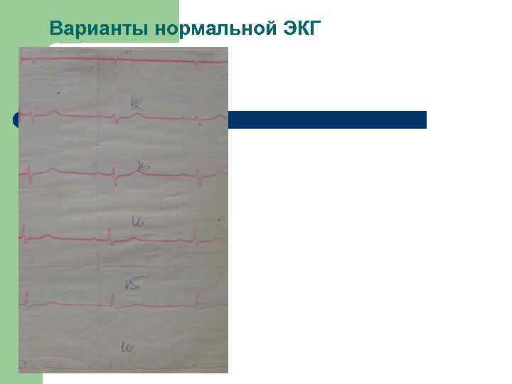 Варианты нормальной ЭКГ 