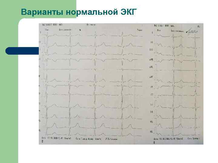 Варианты нормальной ЭКГ 