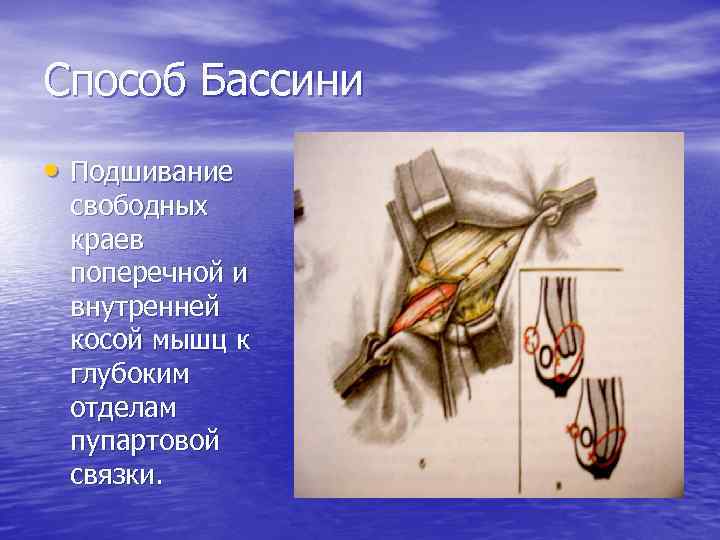 Способ Бассини • Подшивание свободных краев поперечной и внутренней косой мышц к глубоким отделам