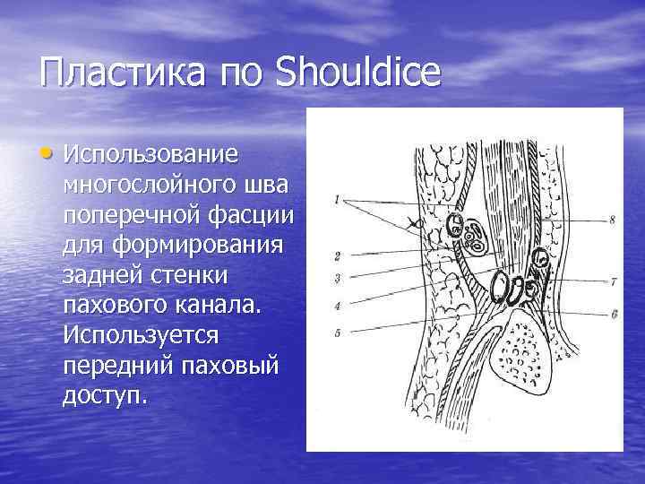 Пластика по Shouldice • Использование многослойного шва поперечной фасции для формирования задней стенки пахового