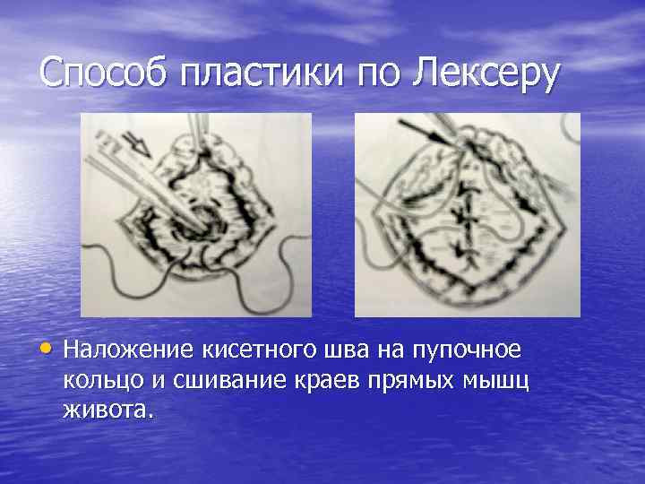 Способ пластики по Лексеру • Наложение кисетного шва на пупочное кольцо и сшивание краев