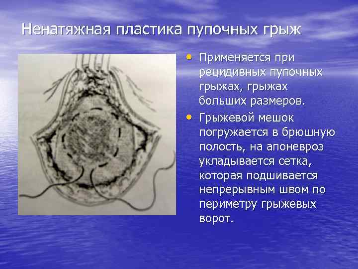 Ненатяжная пластика пупочных грыж • Применяется при • рецидивных пупочных грыжах, грыжах больших размеров.