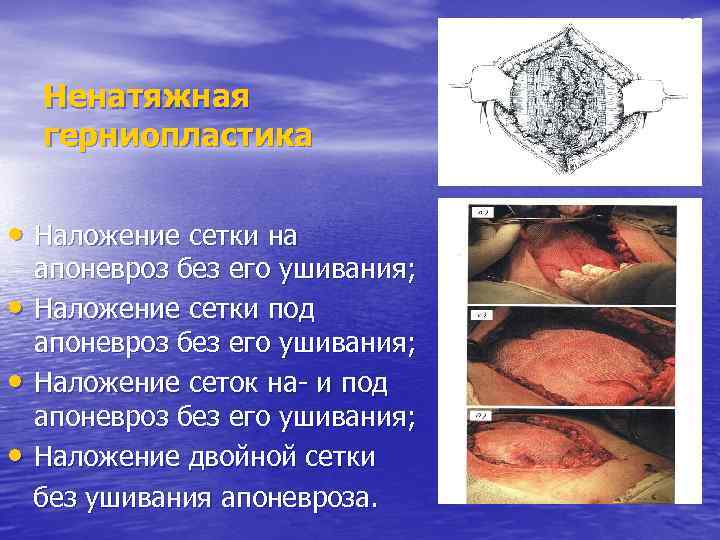 Ненатяжная герниопластика • Наложение сетки на • • • апоневроз без его ушивания; Наложение