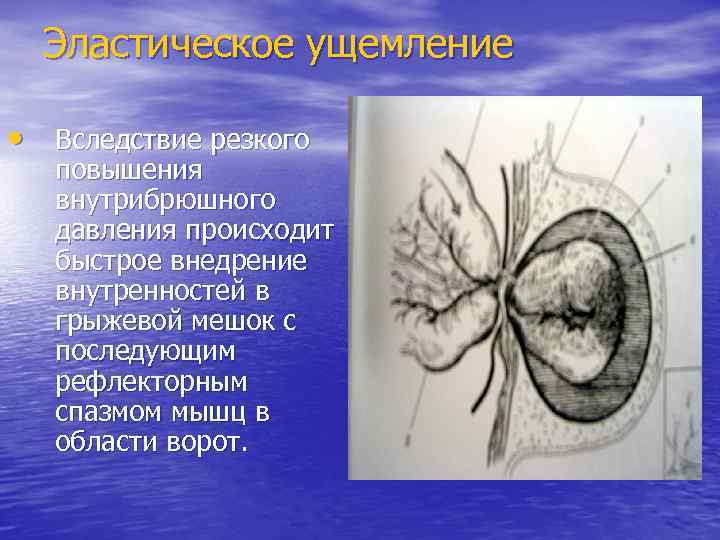 Эластическое ущемление • Вследствие резкого повышения внутрибрюшного давления происходит быстрое внедрение внутренностей в грыжевой