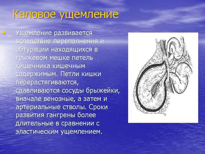 Каловое ущемление • Ущемление развивается вследствие переполнения и обтурации находящихся в грыжевом мешке петель