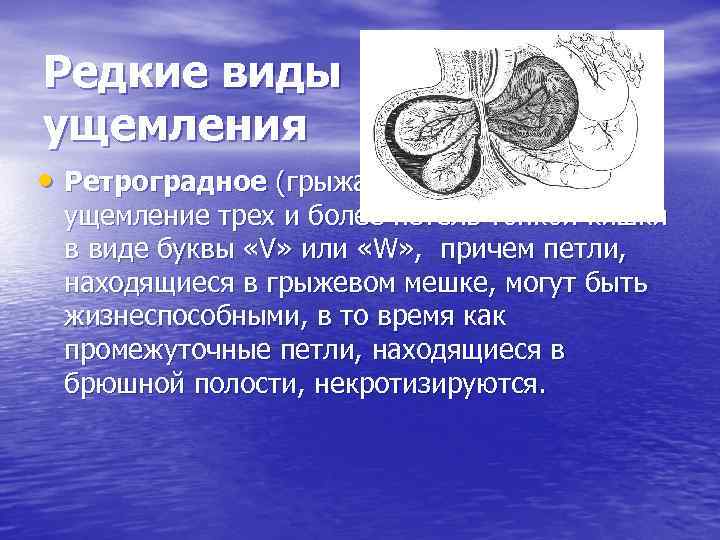 Редкие виды ущемления • Ретроградное (грыжа Майдля): «обратное» ущемление трех и более петель тонкой