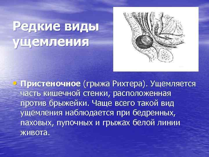 Редкие виды ущемления • Пристеночное (грыжа Рихтера). Ущемляется часть кишечной стенки, расположенная против брыжейки.