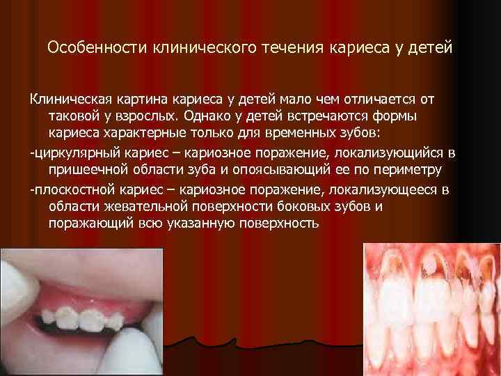 Особенности клинического течения кариеса у детей Клиническая картина кариеса у детей мало чем отличается
