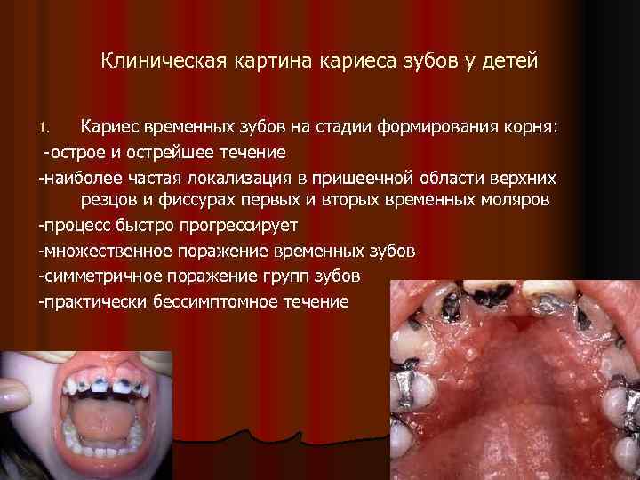 Клиническая картина кариеса зубов у детей Кариес временных зубов на стадии формирования корня: -острое