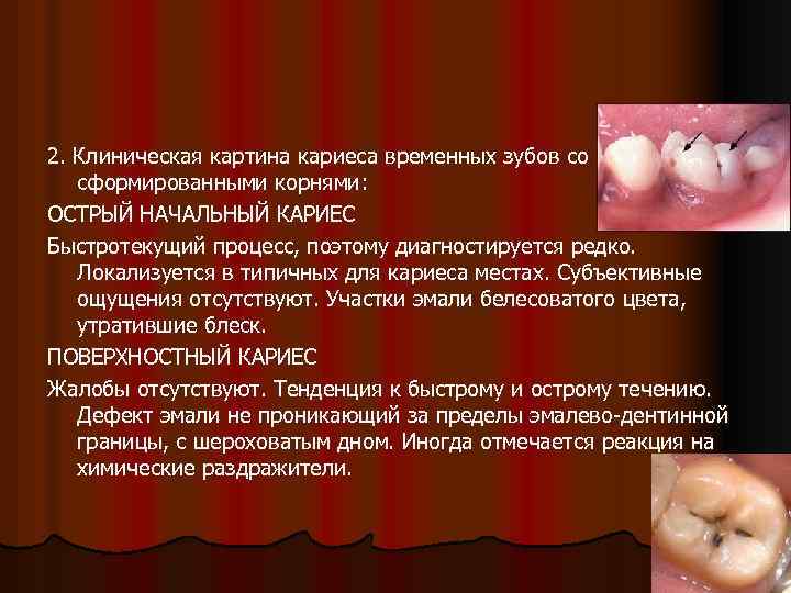 2. Клиническая картина кариеса временных зубов со сформированными корнями: ОСТРЫЙ НАЧАЛЬНЫЙ КАРИЕС Быстротекущий процесс,