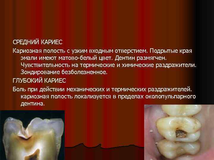 СРЕДНИЙ КАРИЕС Кариозная полость с узким входным отверстием. Подрытые края эмали имеют матово-белый цвет.