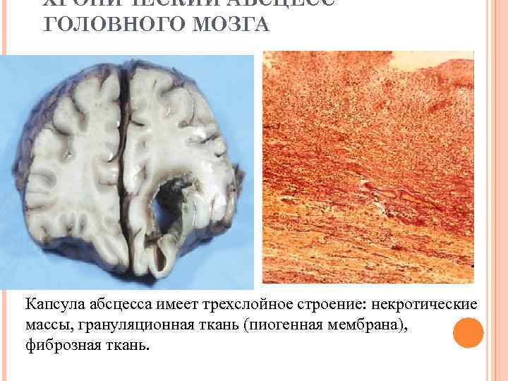 Абсцесс мозга симптомы