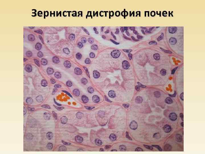 Зернистая дистрофия почек 