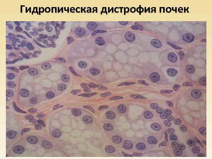 Гидропическая дистрофия почек 