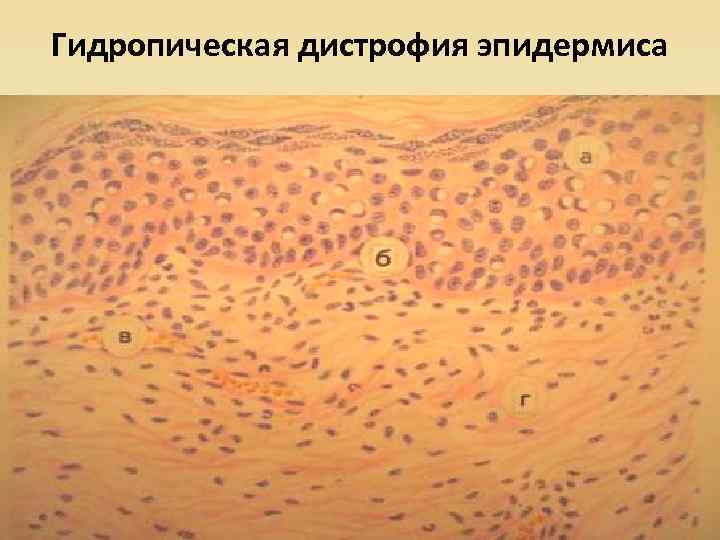 Гидропическая дистрофия эпидермиса 