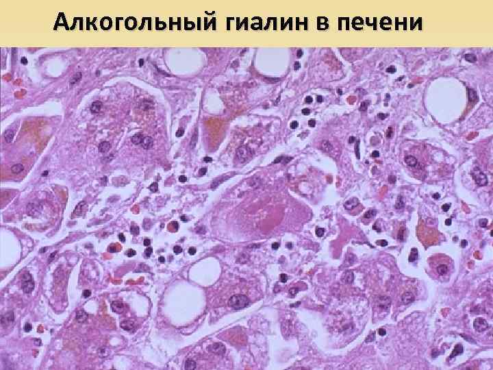 Алкогольный гиалин в печени 