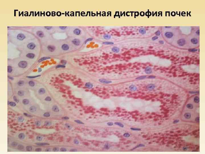 Гиалиново-капельная дистрофия почек 