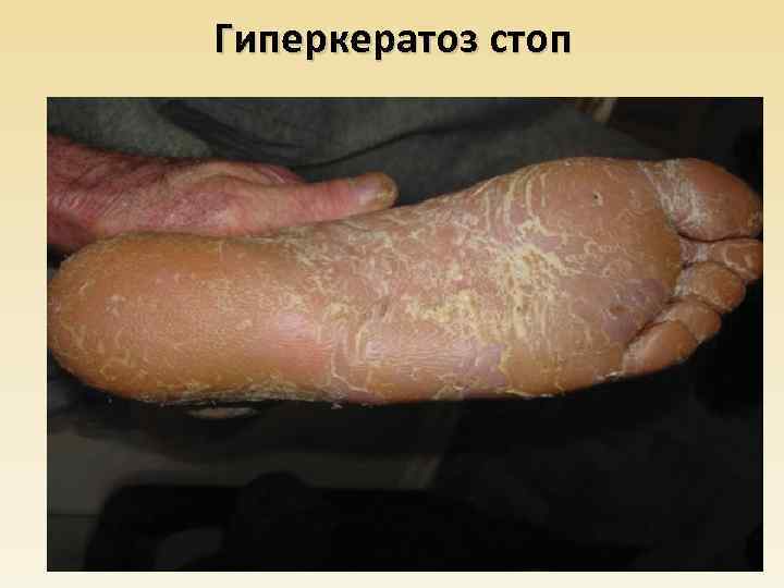Гиперкератоз стоп 