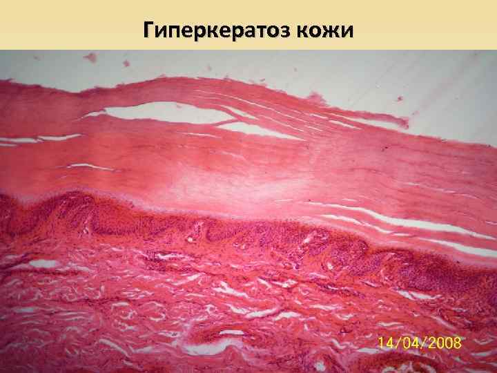 Гиперкератоз кожи 