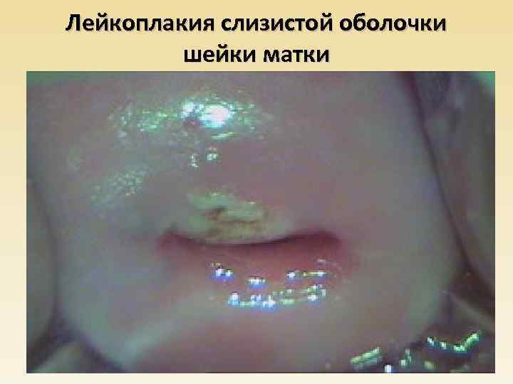Лейкоплакия слизистой оболочки шейки матки 