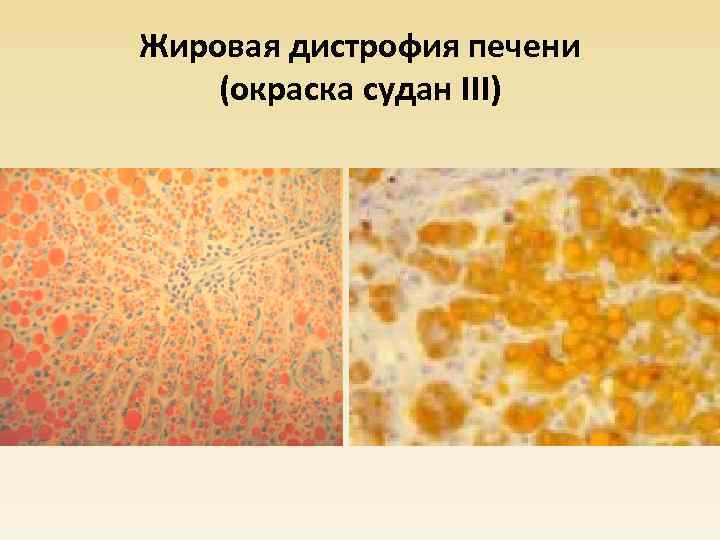 Жировая дистрофия печени (окраска судан III) 