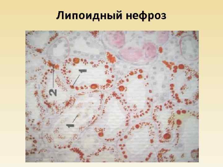 Липоидный нефроз 
