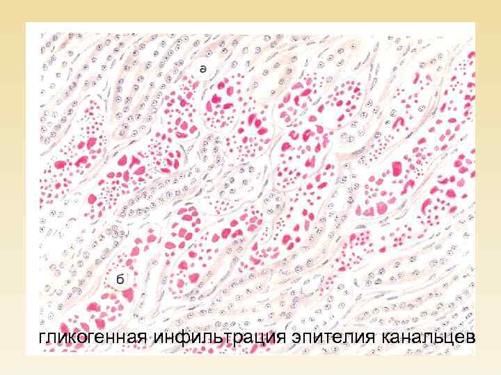гликогенная инфильтрация эпителия канальцев 