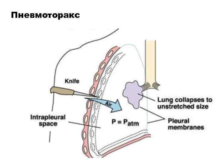 Пневмоторакс 