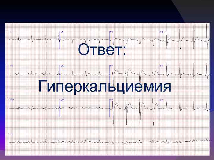 Ответ: Гиперкальциемия 