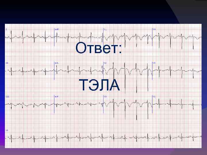 Ответ: ТЭЛА 