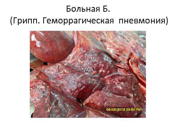 Больная Б. (Грипп. Геморрагическая пневмония) 