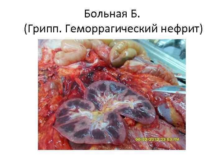 Больная Б. (Грипп. Геморрагический нефрит) 