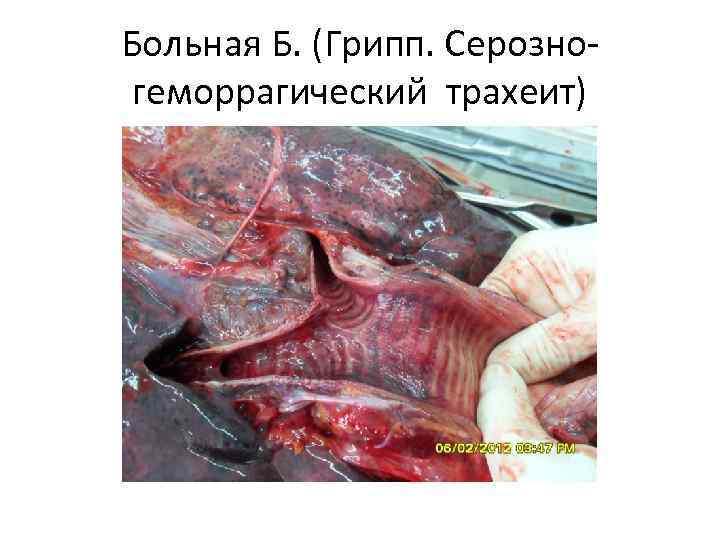 Больная Б. (Грипп. Серозно- геморрагический трахеит) 