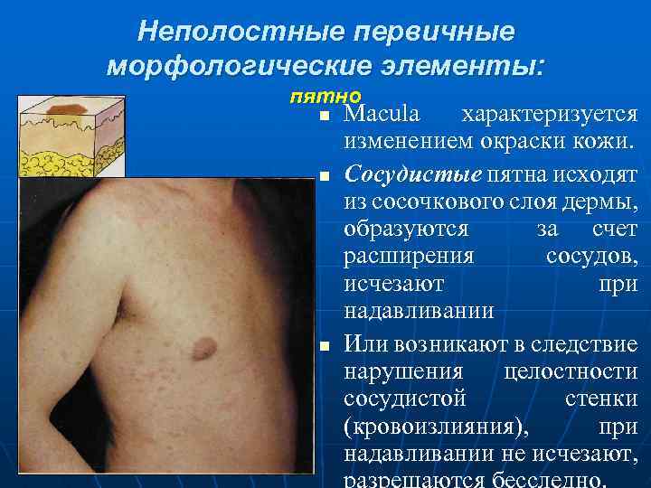  Неполостные первичные морфологические элементы: пятно n Macula характеризуется изменением окраски кожи. n Сосудистые