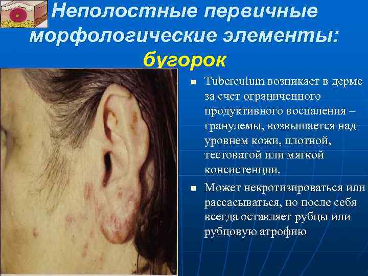  Неполостные первичные морфологические элементы: бугорок n Tuberculum возникает в дерме за счет ограниченного