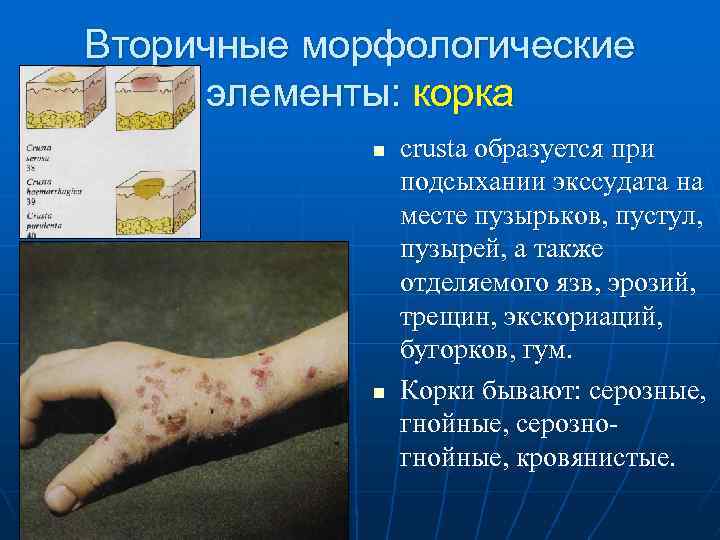 Вторичные морфологические элементы: корка n crusta образуется при подсыхании экссудата на месте пузырьков, пустул,