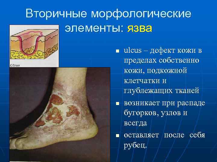 Вторичные морфологические элементы: язва n ulcus – дефект кожи в пределах собственно кожи, подкожной