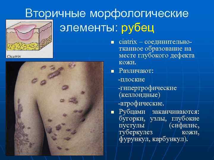 Вторичные морфологические элементы: рубец n ciatrix – соединительно тканное образование на месте глубокого дефекта