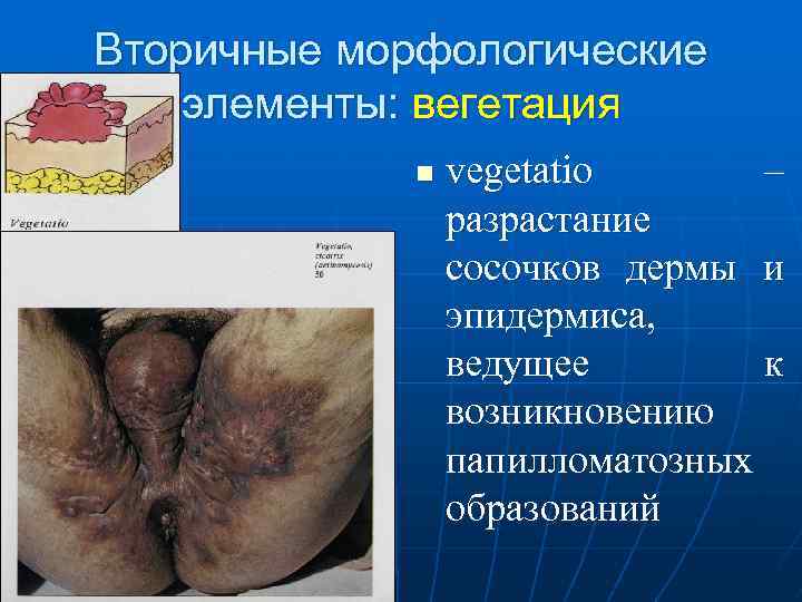 Вторичные морфологические элементы: вегетация n vegetatio – разрастание сосочков дермы и эпидермиса, ведущее к